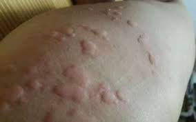 Self-Healed Urticaria and Shingles with PaidaLajn